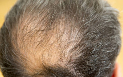 Don’t Pull Your Hair Out: Hair Transplant Post-Op Info
